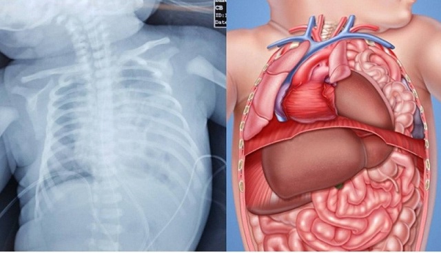 Khiếm khuyết cơ thành bụng - Hình ảnh minh họa